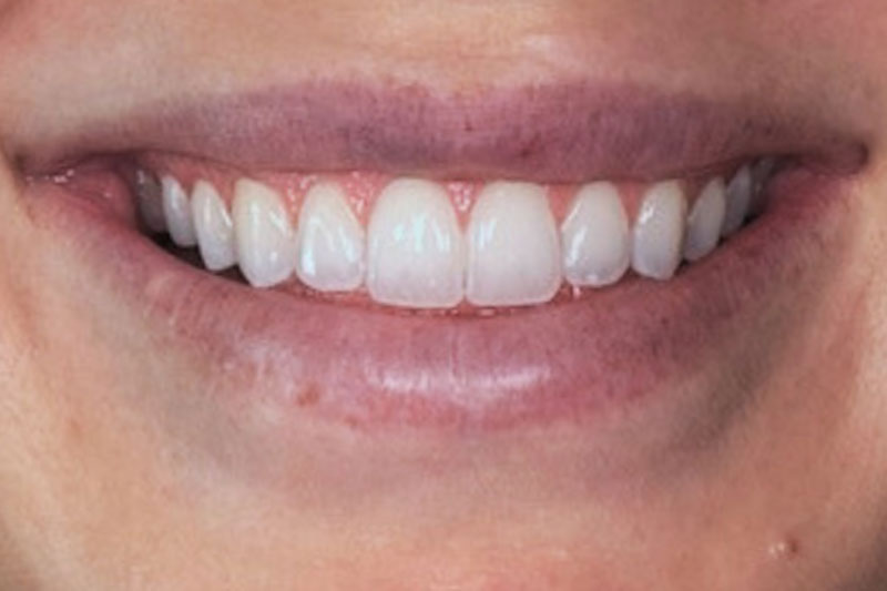 Teeth Whitening in Parkville